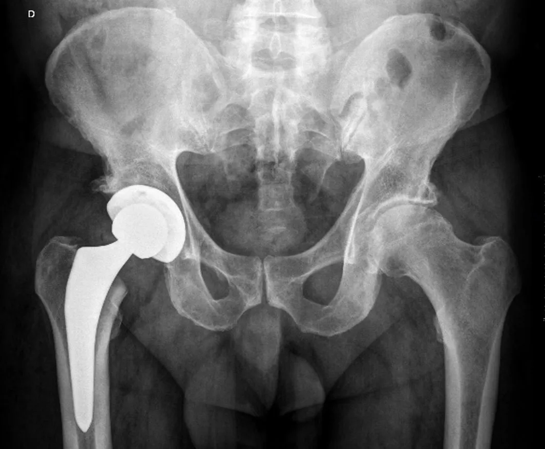 Cirurgia do Quadril - prótese e fratura do colo do fêmur